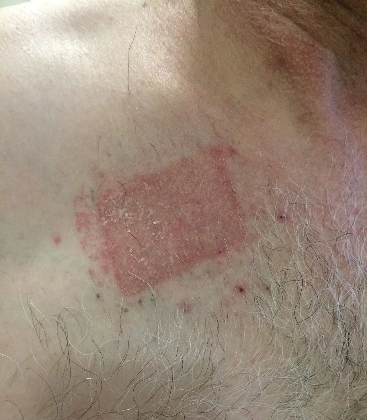 Severe contact dermatitis from a transdermal patch — the same irritant mechanism propylene glycol triggers on the scalp in roughly 6% of liquid minoxidil users. Sharp erythema and scaling outline the application site.
