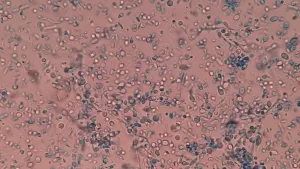Ketoconazole Shampoo for Hair Loss: What 27 Years of Evidence Actually Show (2026)