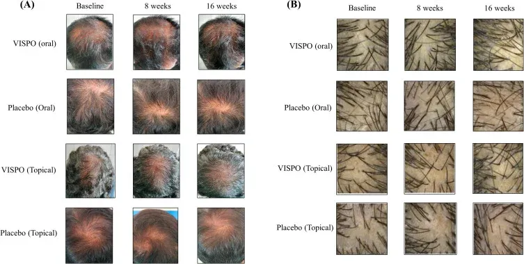 Vertex scalp before and after 16 weeks of standardized saw palmetto oil treatment, with paired phototrichogram analysis showing increased hair density